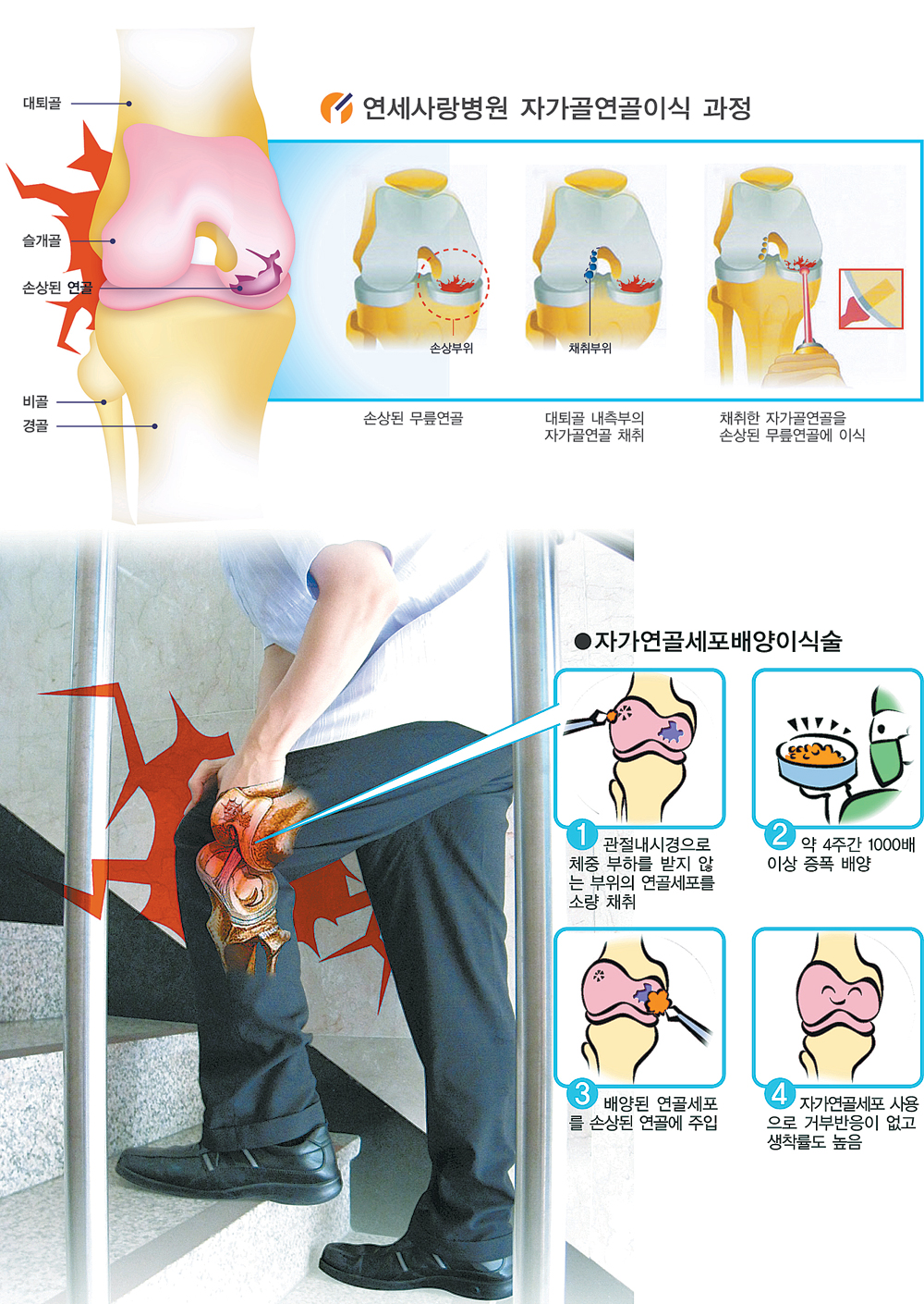 건강]“평생 관절 건강, 연골부터 챙기세요”｜동아일보